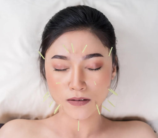 Rejuvenecimiento Facial con Acupuntura
